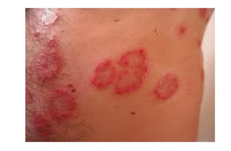 Treatment of fungal infection