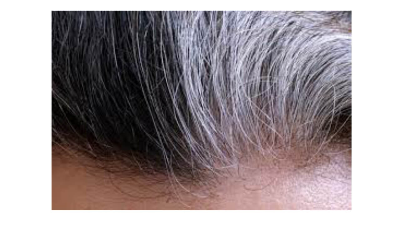 Premature graying of hair